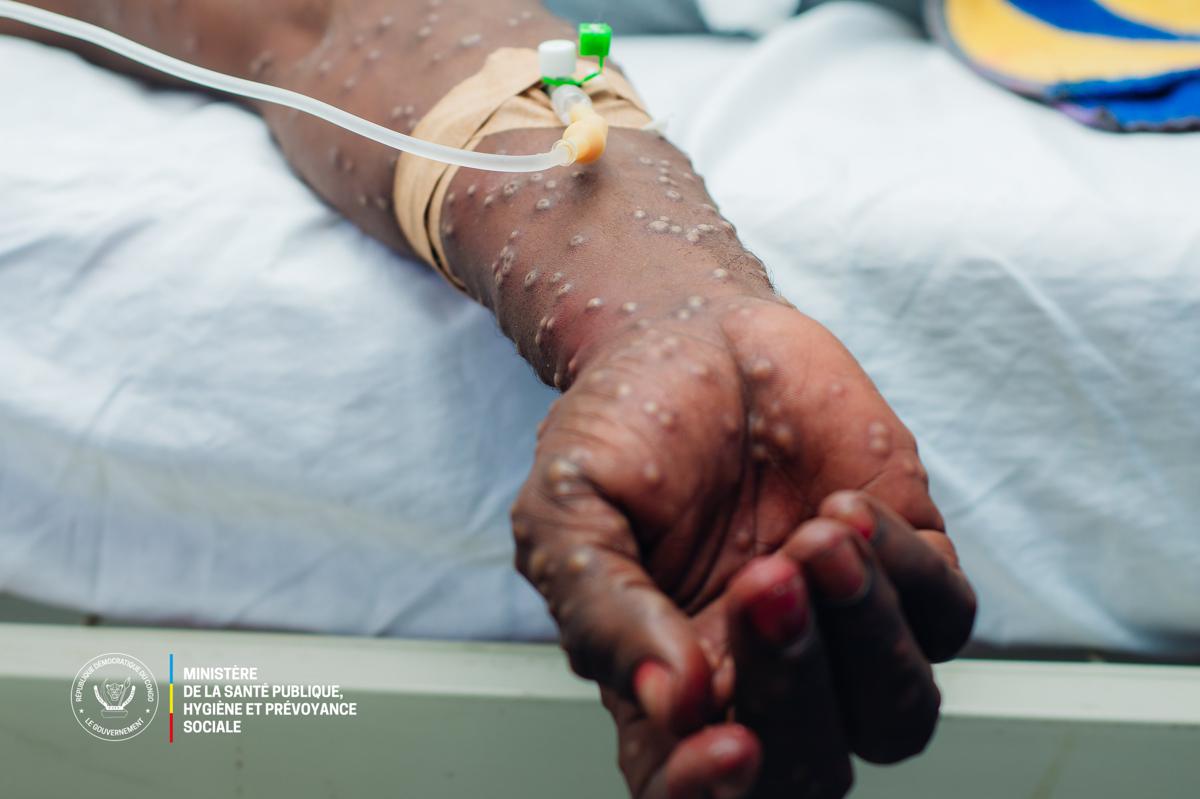 bitmap_1200_nocrop_1_1_20241028101048371137_Mpox